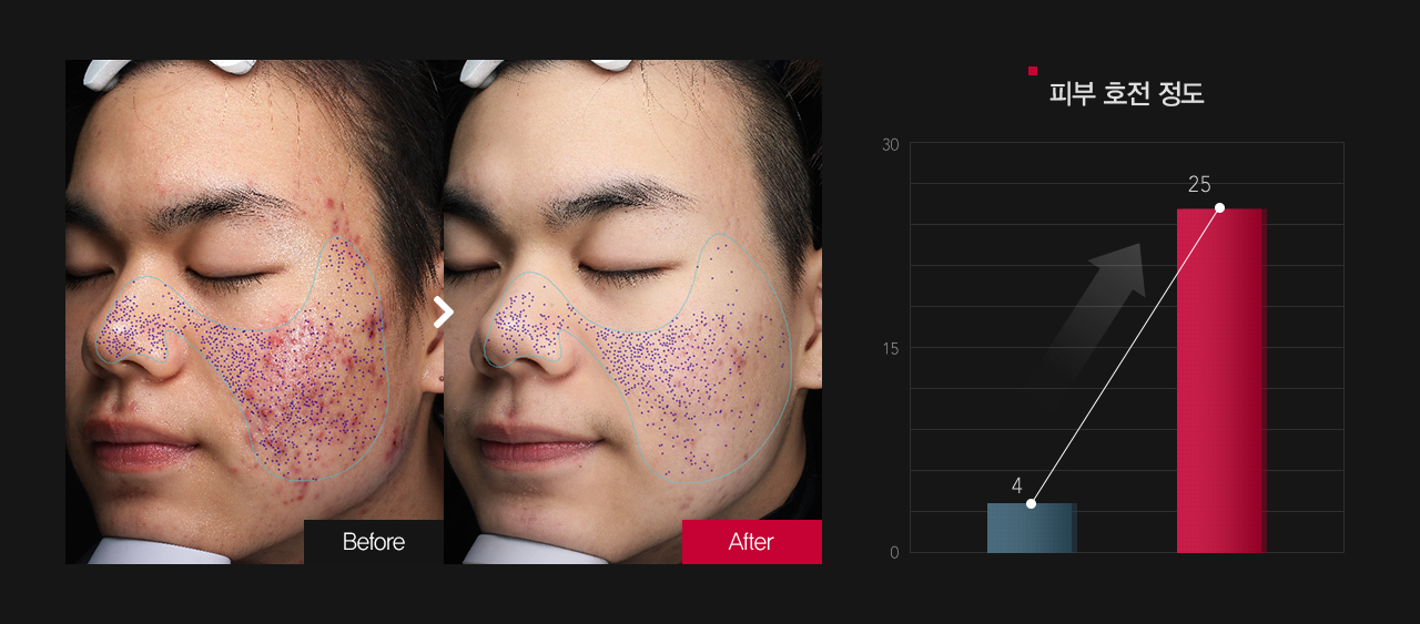 모공 호전정도